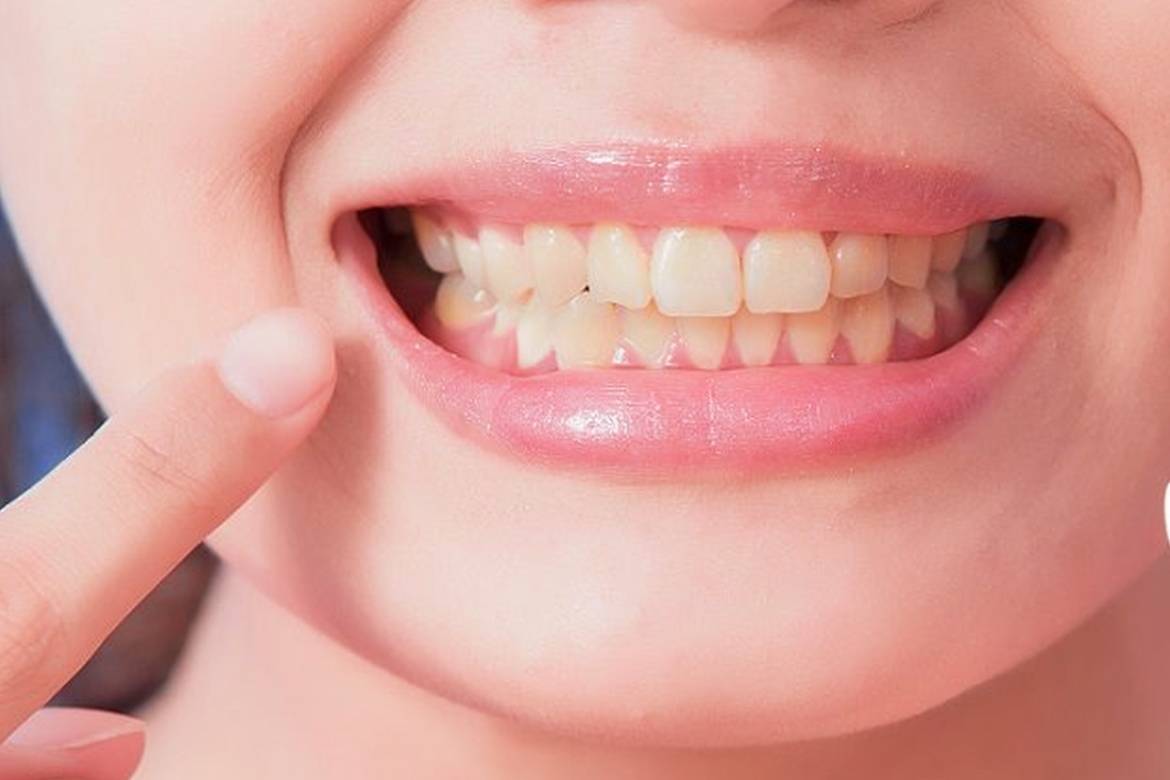 Жёлтые зубы у ребенка: причины и лечение желтого налета на зубах