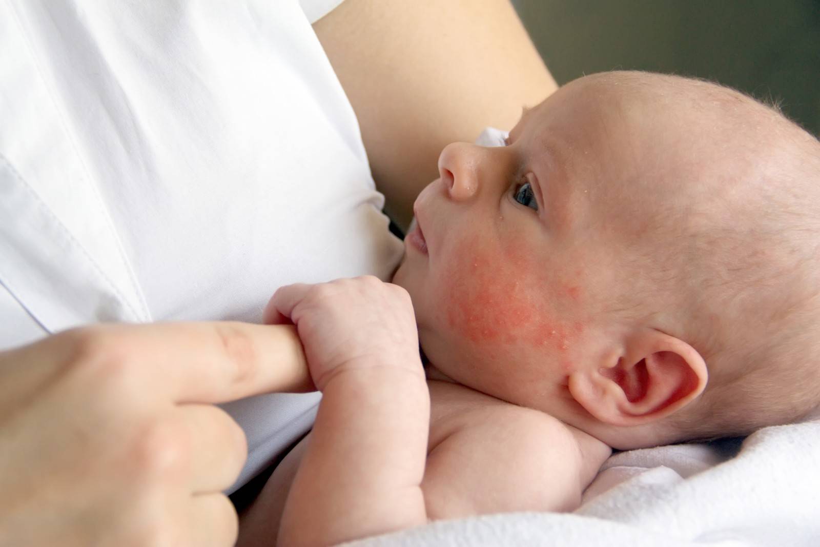 Аллергия у новорожденных и грудничков - как выглядит, чем лечить