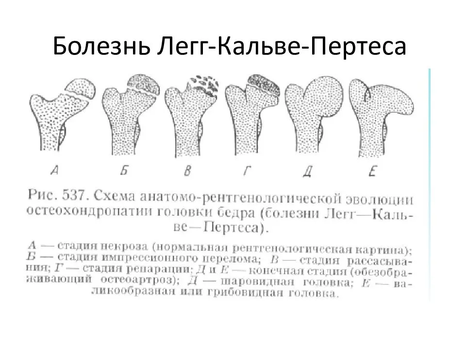 Болезнь пертеса у детей - лечение в минске (беларусь) | ortoped.by
