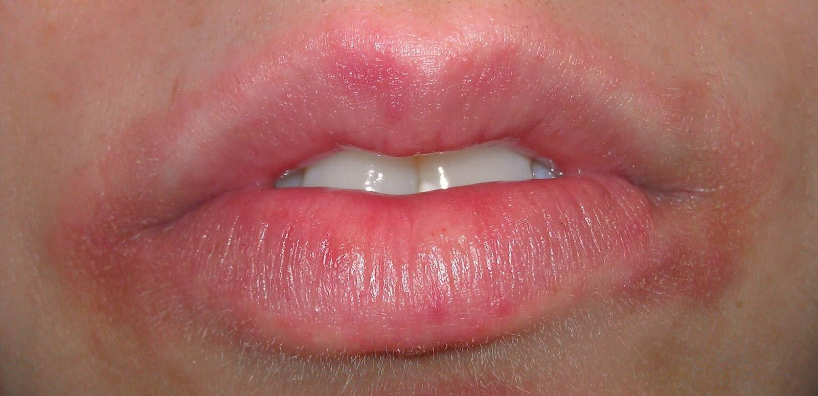 Пероральный дерматит у детей: лечение, фото сыпи вокруг рта, на подбородке и лице