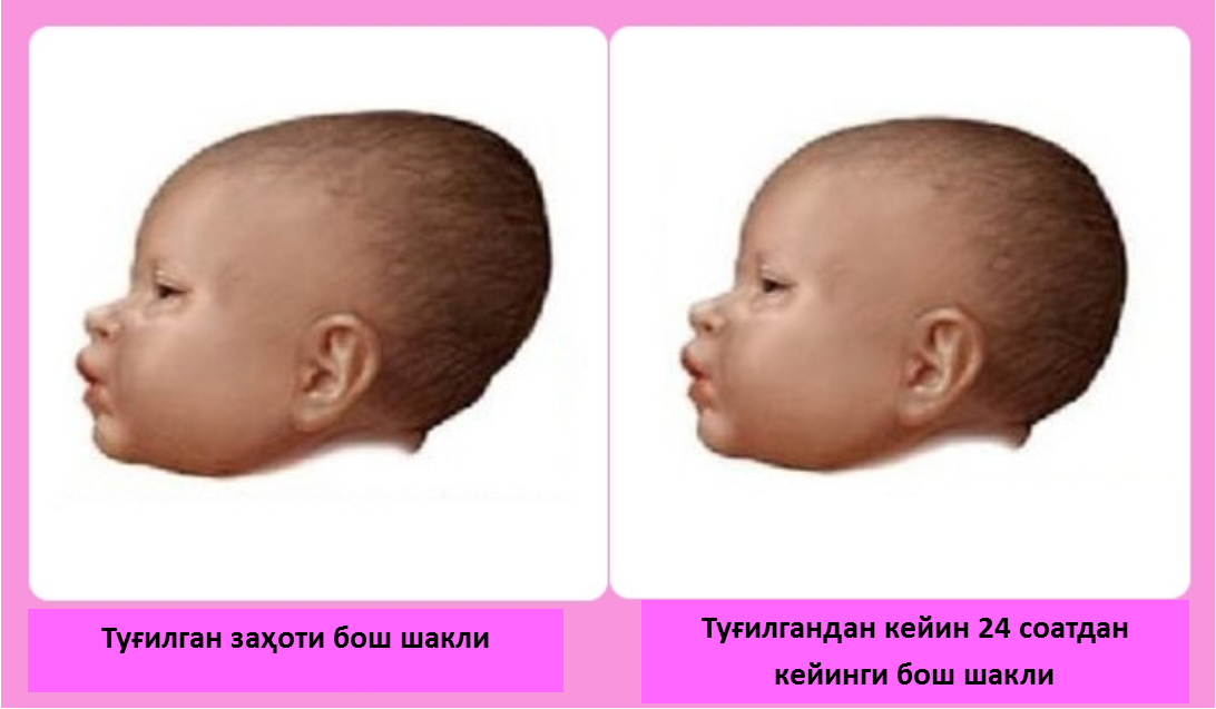 Пульсирует родничок в 4 месяца