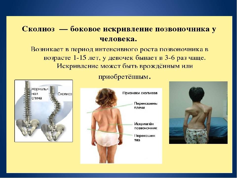 Сколиоз у детей: как лечить? | 1дмц