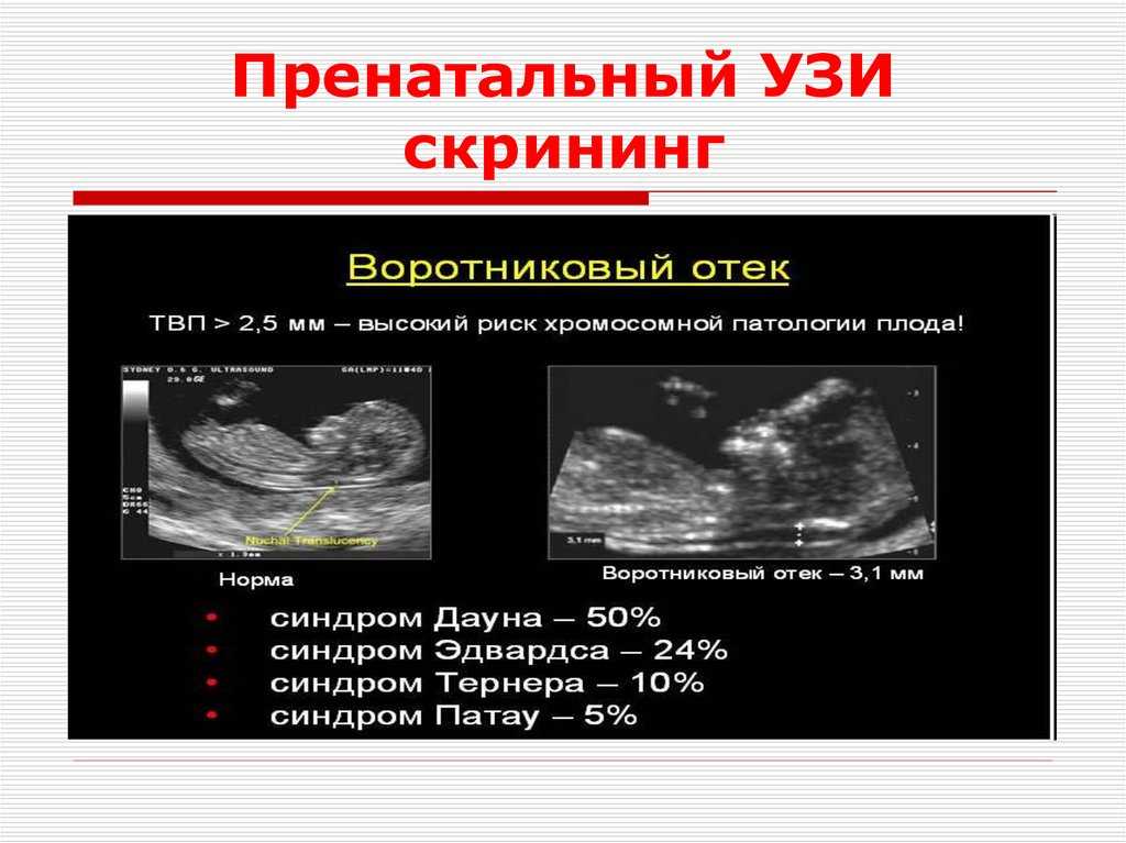 Патологии сердца плода, которые можно определить на скрининговом узи