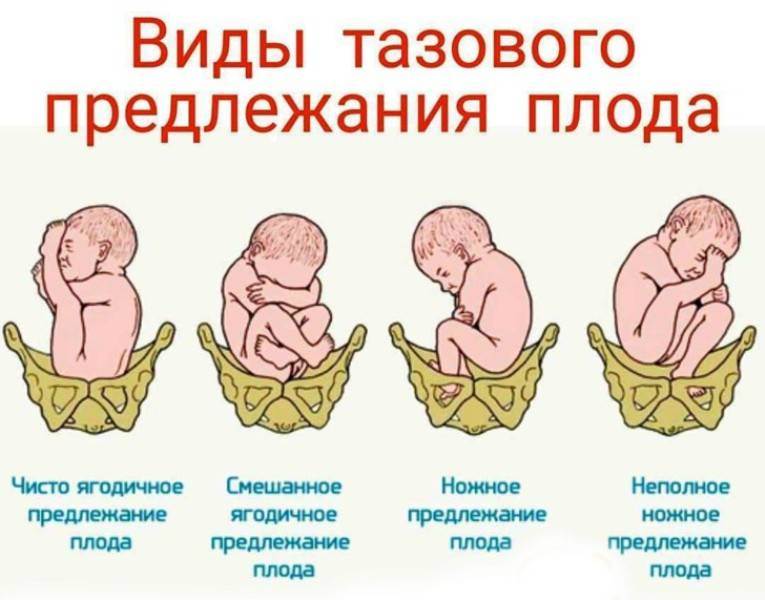 Правильное положение плода перед родами