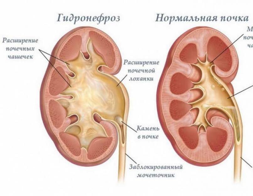 Гидронефроз почек у новорожденных: диагностика и лечение