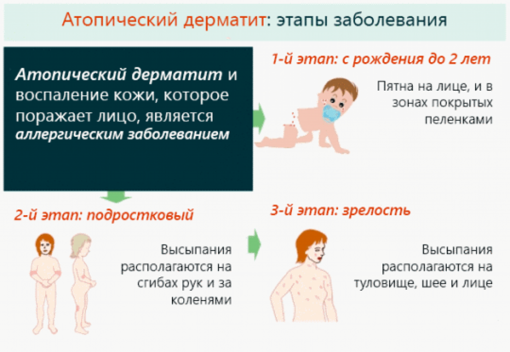 Как выглядит дерматит у детей: фото ребенка, симптомы у новорожденных, грудничка