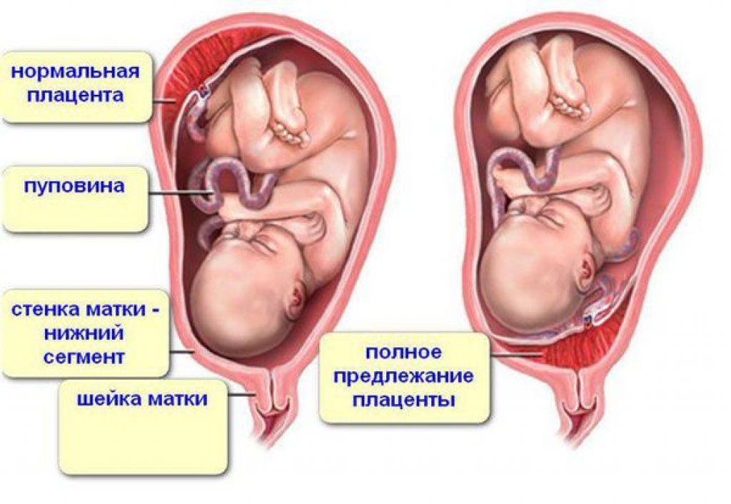 Низкая плацентация при беременности, что можно и нельзя делать при предлежании плаценты, расположение на 20 и 21 неделе