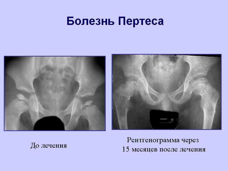 Болезнь пертеса (остеохондропатия тазобедренного сустава) у детей: причины и симптомы заболевания, принципы лечения