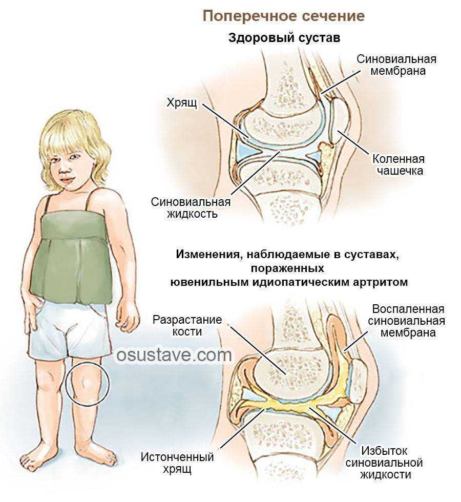 Реактивный артрит у ребенка: симптомы, причины и лечение, последствия