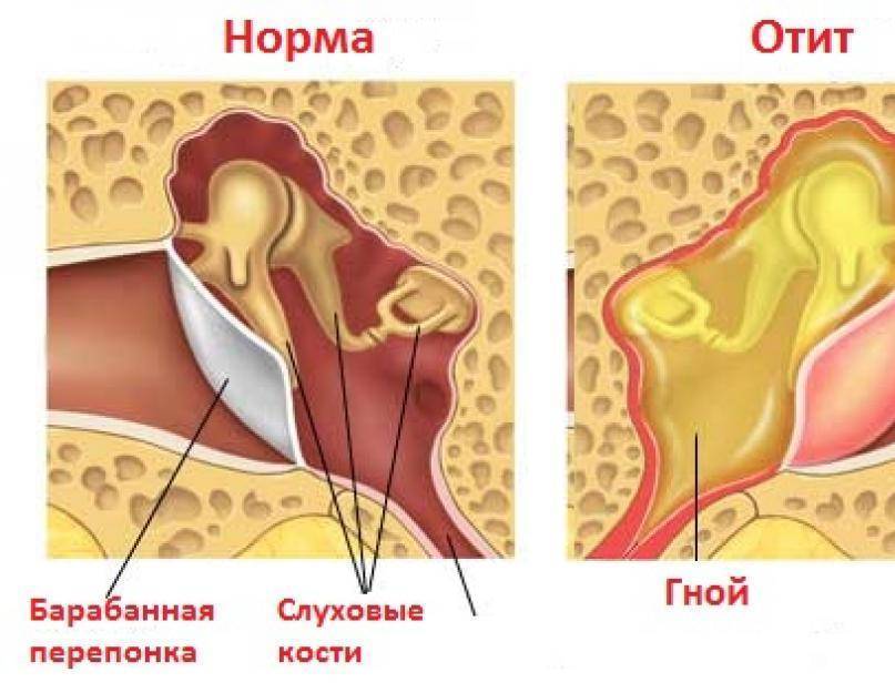 Пахнет из уха у грудничка, причины и последствия | nosoglot.ru