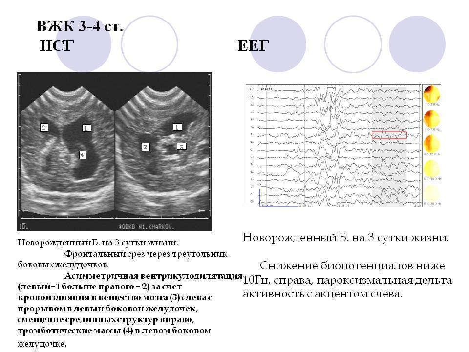 Псевдокиста головного мозга у новорожденных детей: причины и методы лечения | parnas42.ru
