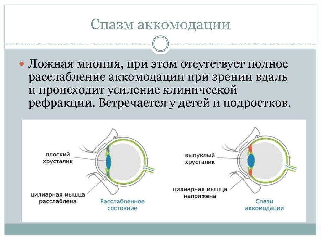 Cпазм аккомодации у детей: лечение, причины и симптомы патологии