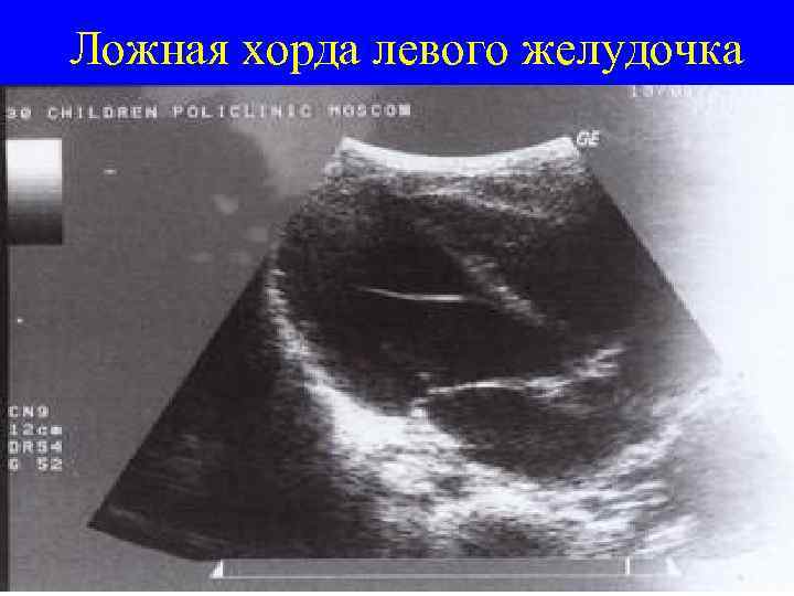Дополнительная хорда в сердце у ребенка. важно знать. • интим-косметика