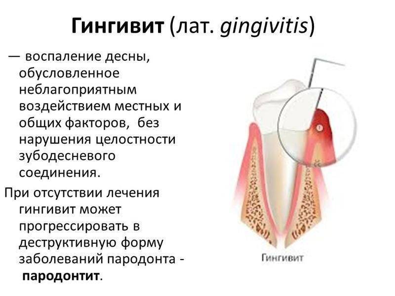 Гингивит у детей – симптомы, лечение, причины