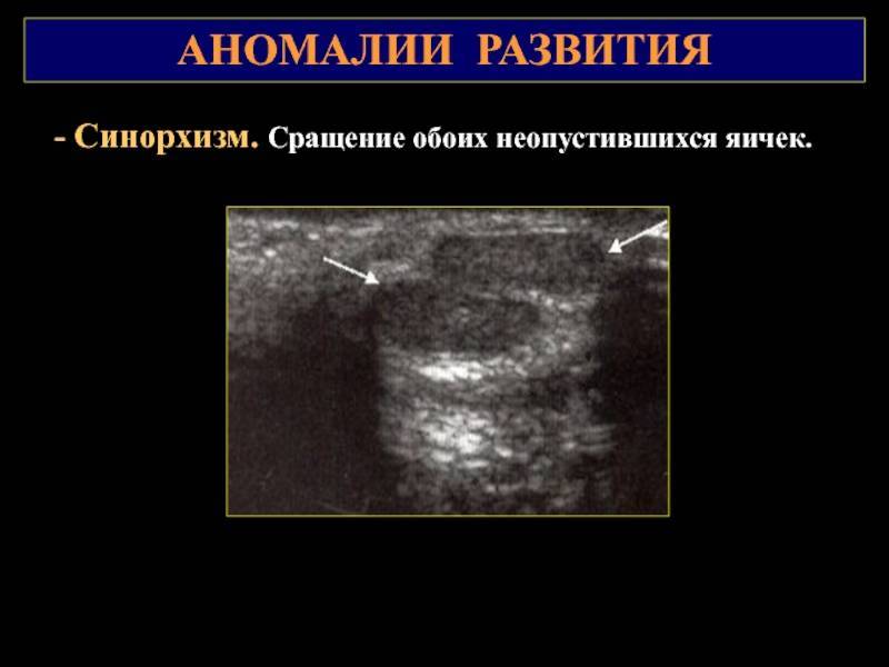 Симптомы гипоплазии яичек у мальчиков, причины дисфункции и схема лечения