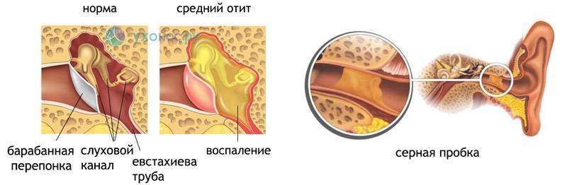 Как выгнать воду из уха. Тубоотит барабанная перепонка. Барабанная перепонка отит. Евстахиит барабанная перепонка.