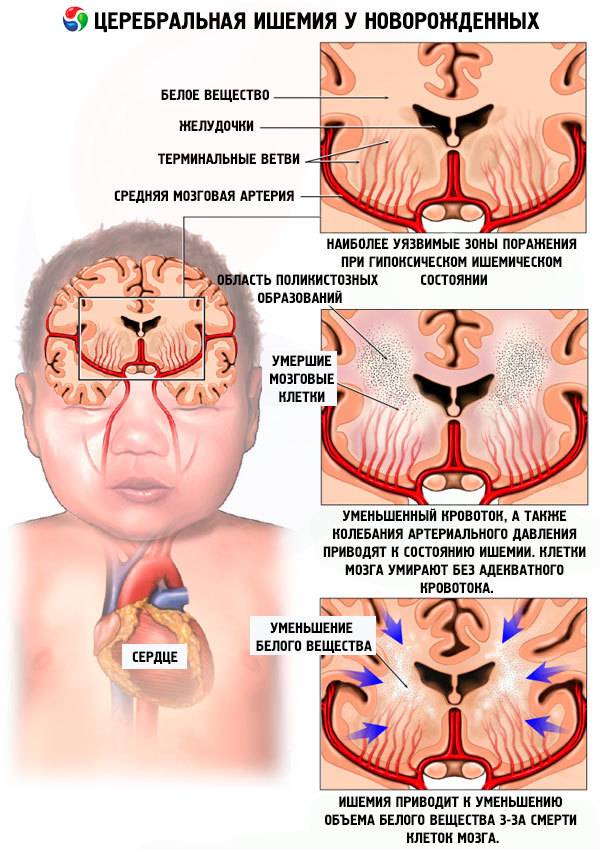 Киста головного мозга у новорожденного 📌 (в голове): субэпендимальная, сосудистая