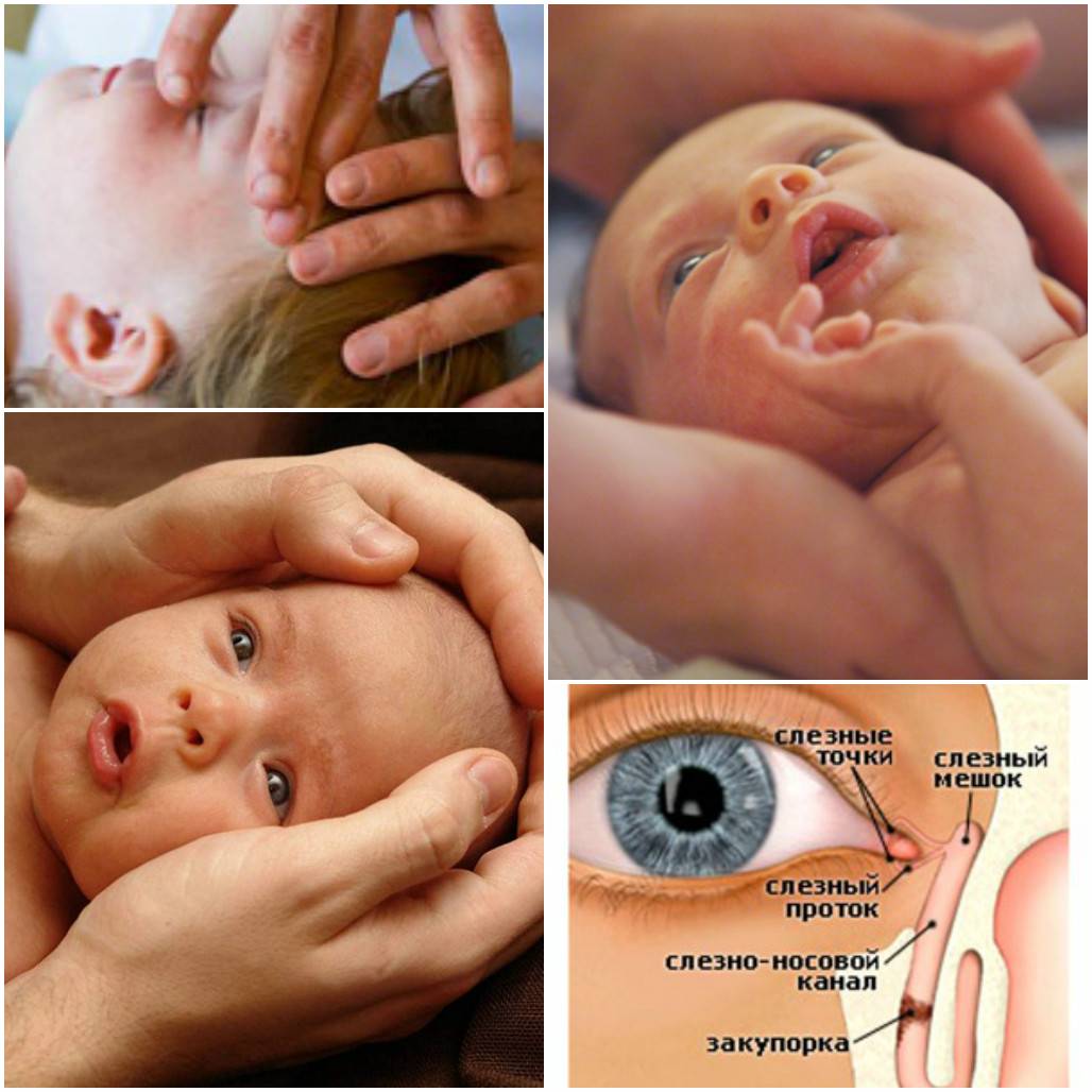 3 ведущих причины и 7 возможных осложнений дакриоцистита у новорождённых