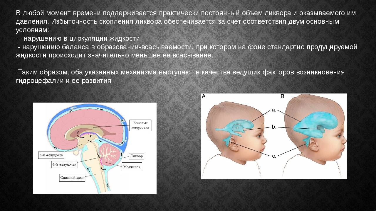 Как обработать водянку головного мозга у новорожденного: причины, симптомы и лечение