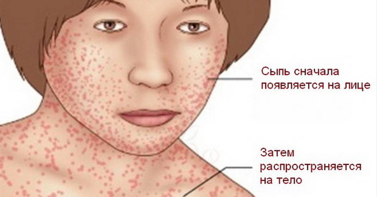 Сыпь у ребенка на лице: возможные причины, все виды высыпаний с фото и методы лечения прыщиков
