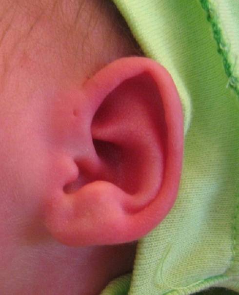 У ребенка сильно опухла мочка и покраснело ухо: почему оно чешется и горячее, какие причины аллергии и что делать?