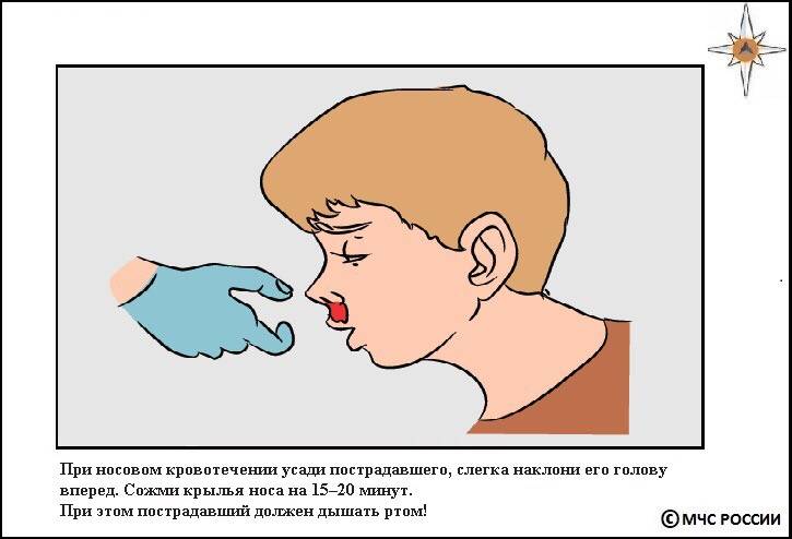 Носовое кровотечение при ударе