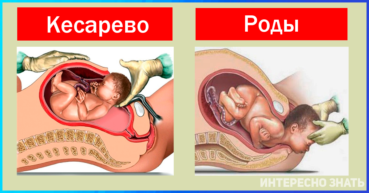 Особенности развития детей после оперативных родов с помощью кесарева сечения — моироды.ру