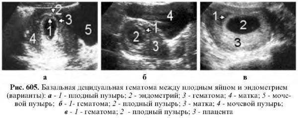 Отслойка плаценты на ранних сроках | уроки для мам
