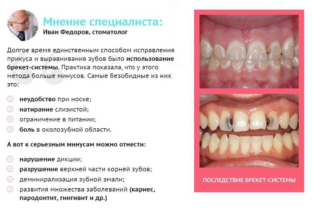 Пластинки для зубов для детей, фото: сколько стоит, как и когда ставят?
