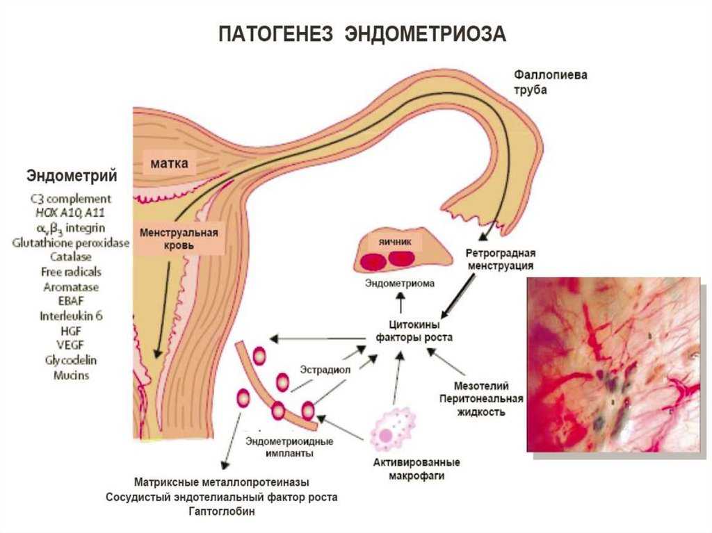 Кровотечение при эндометриозе матки: симптомы, причины и методы лечения | немедик