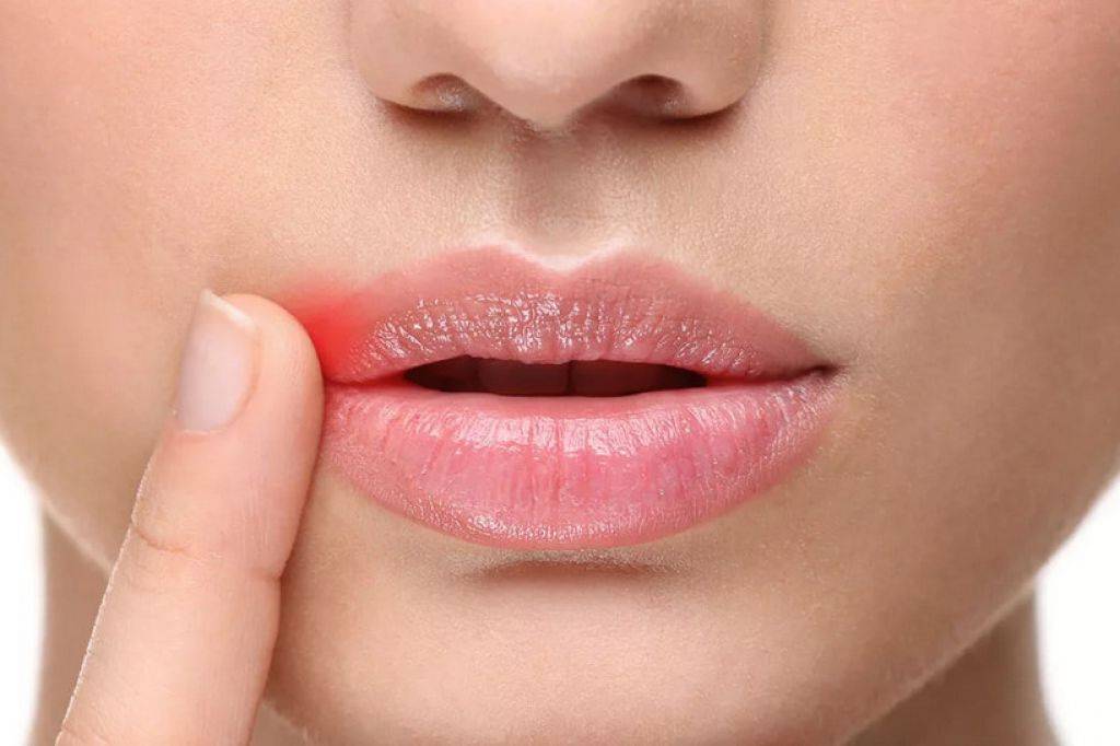 Болячки в уголках губ у ребенка - как правильно лечить?
