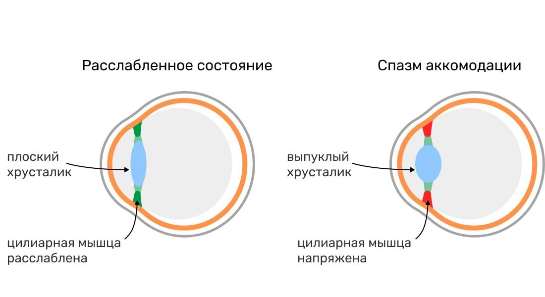 Нарушение зрения