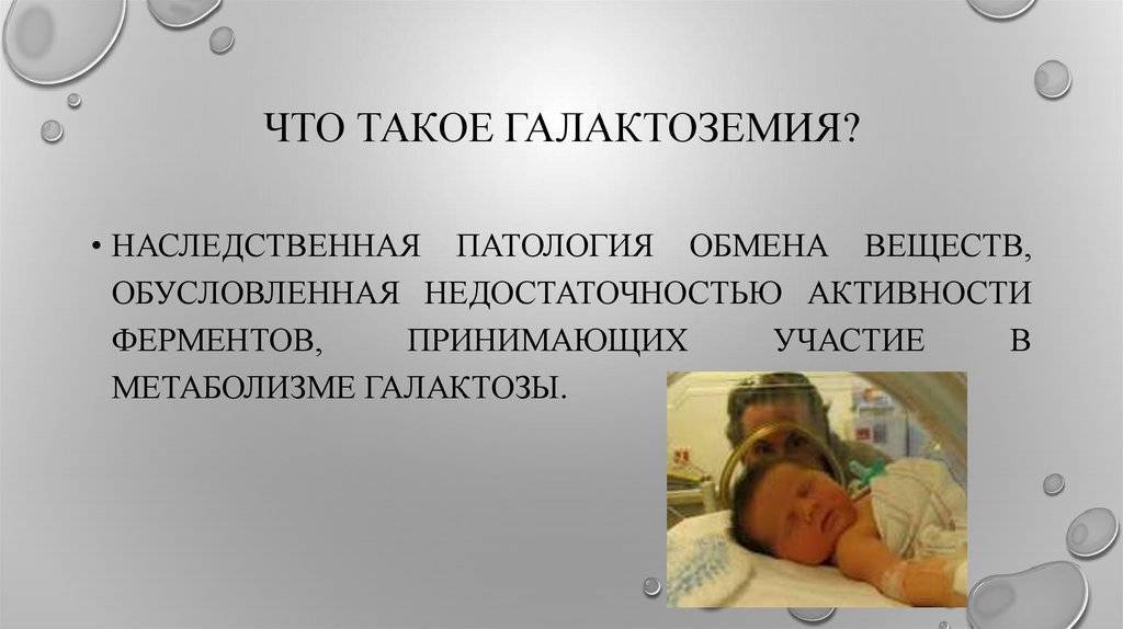 Галактоземия
