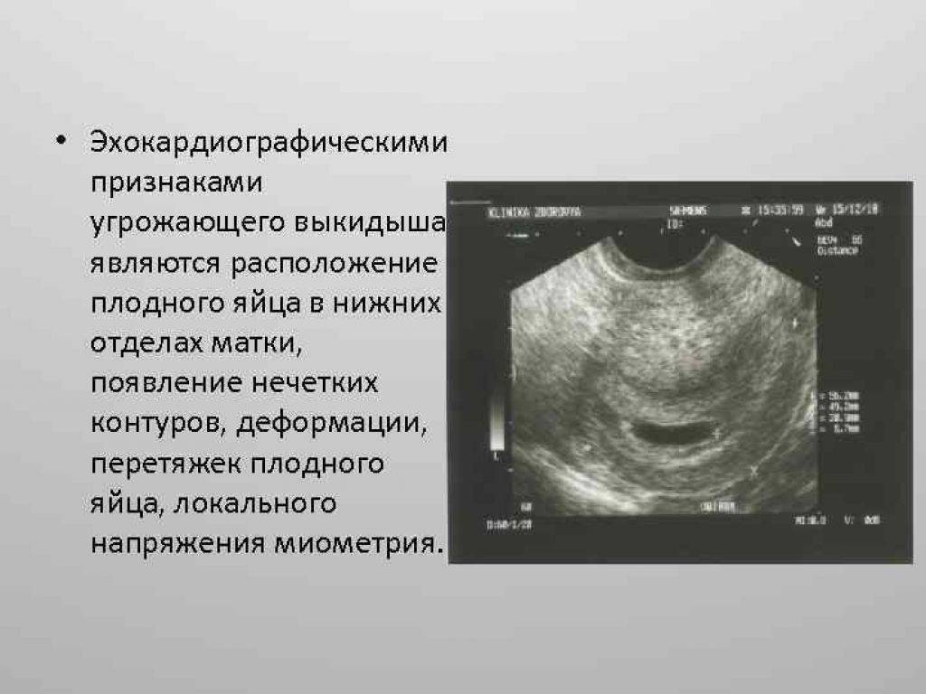 Отслойка эндометрии. Маточная беременность на УЗИ на раннем сроке. Неразвивающаяся беременность УЗИ. Плодное яйцо в матке на раннем сроке УЗИ.