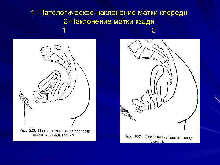 Позы для зачатия при загибе матки