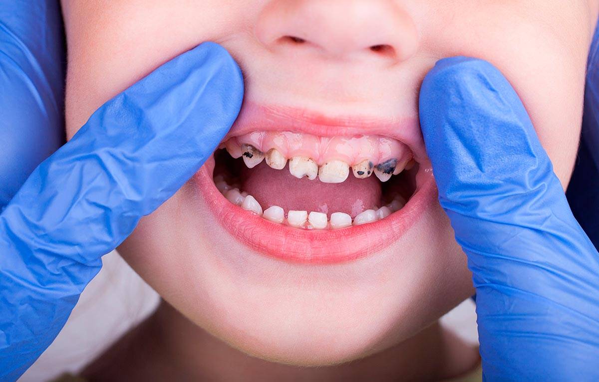 На зубе желтое пятно у ребенка и у взрослого: причины, как убрать, лечение