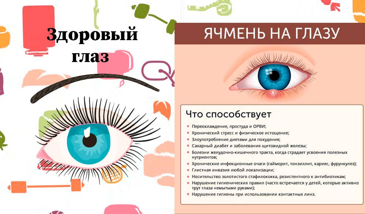 Ячмень у ребенка - как и чем лечить
