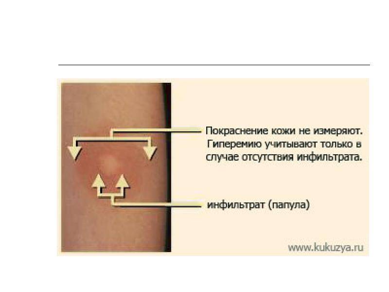 На какой день проверяют манту у ребенка