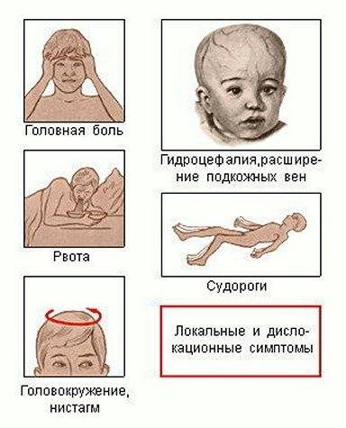 Водянка головного мозга у новорожденного: симптомы, лечение