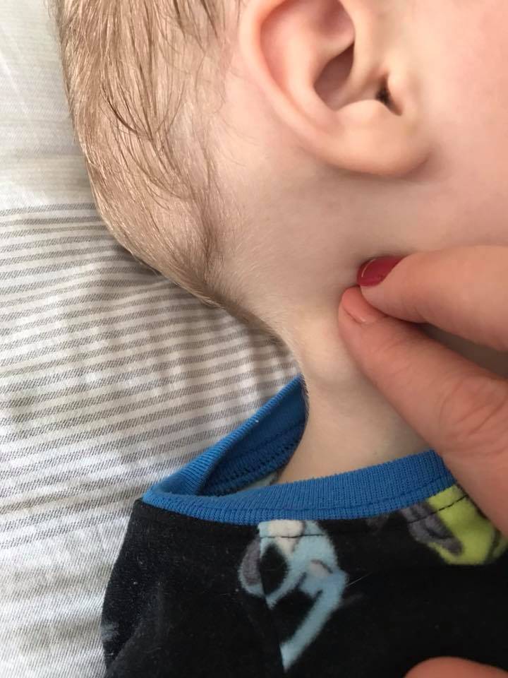Воспалился лимфоузел за ухом у ребенка: причины, симптомы и лечение