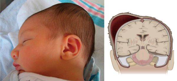 Гематома на голове у новорожденного: после родов, послеродовая, чем опасна, что делать