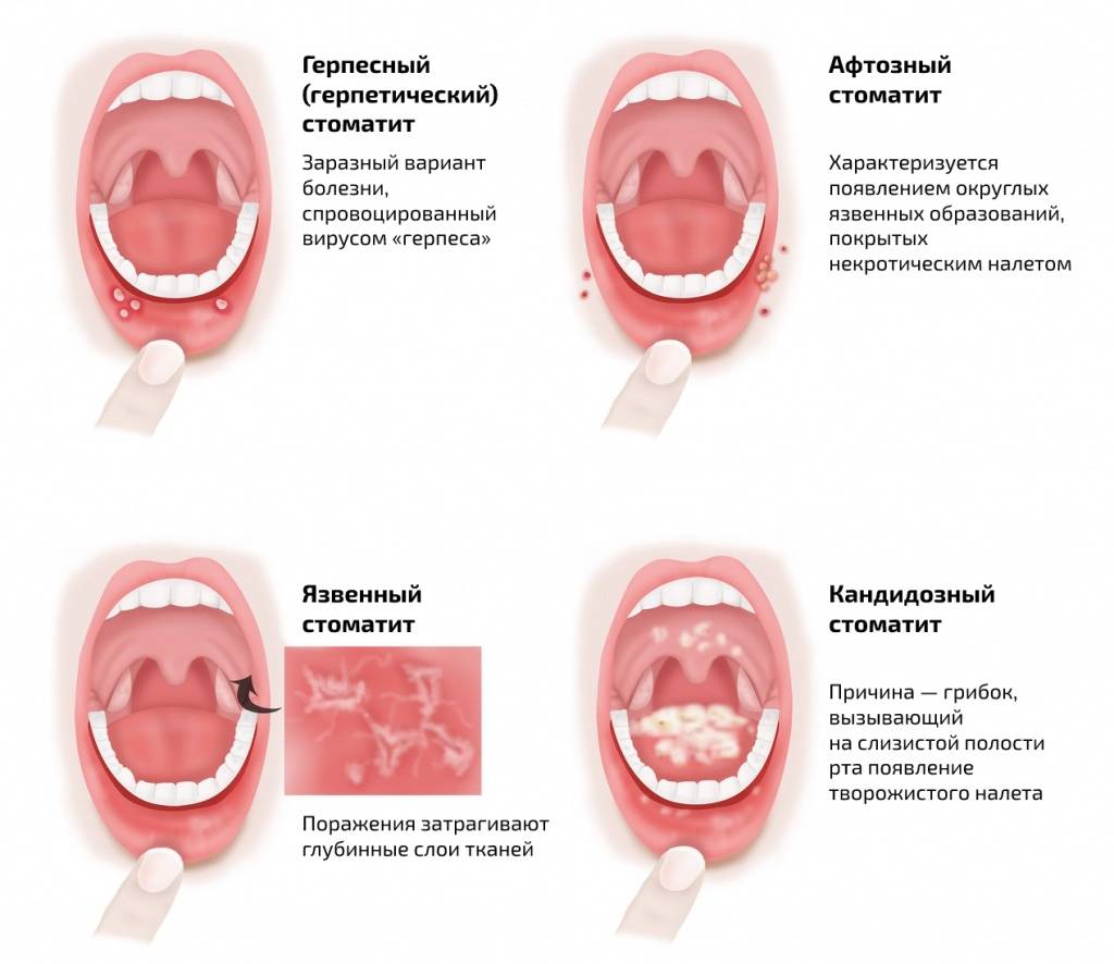 Язвы в полости рта – клинические признаки при различных заболеваниях
