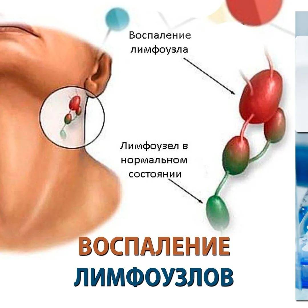 Что делать, если у ребенка на шее увеличены лимфоузлы: причины воспаления и лечение в домашних условиях