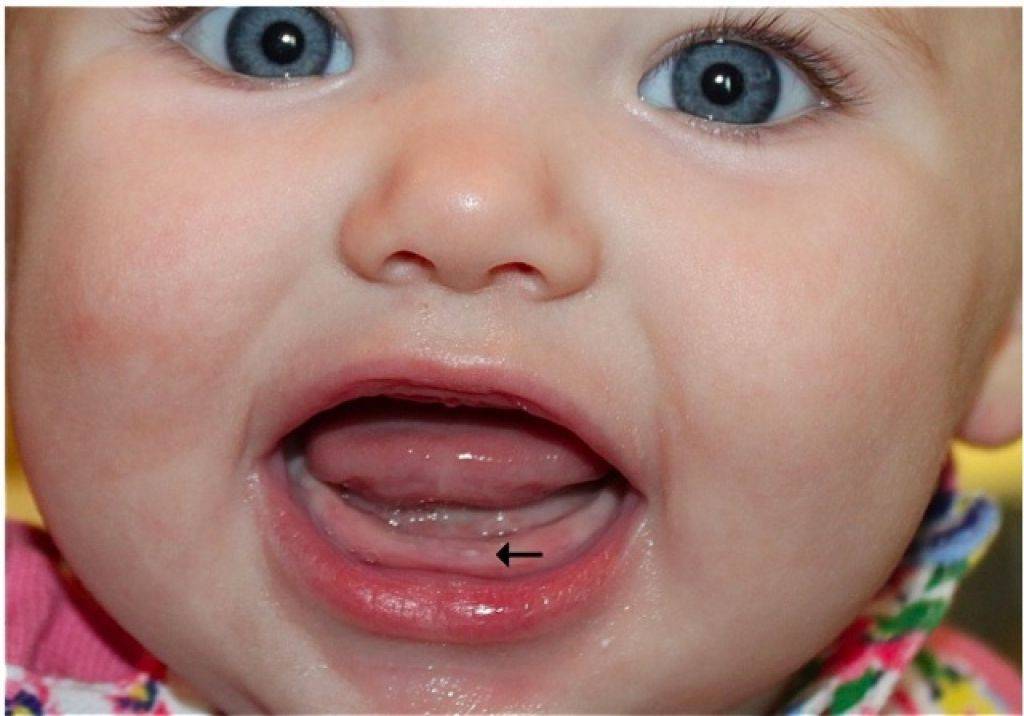 Сколько длится прорезывание зубов у ребенка