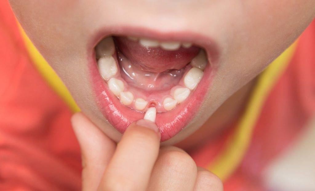Синяя десна при прорезывании зубов у ребенка: почему появилась черная или фиолетовая гематома?