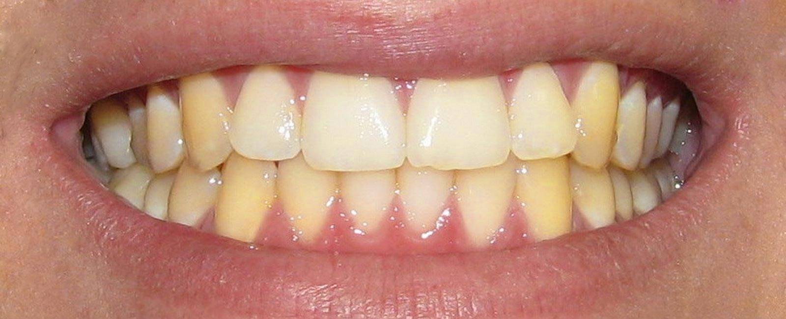 Белые пятна на зубах у ребенка: причины появления, лечение