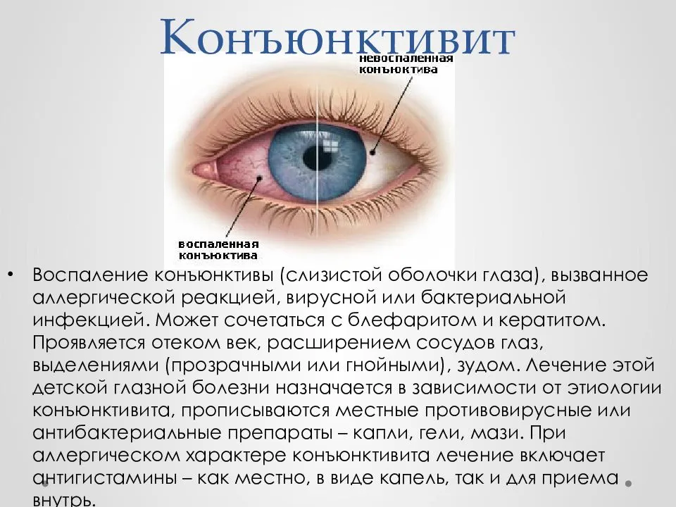 10 советов родителям при аллергическом конъюнктивите у ребёнка