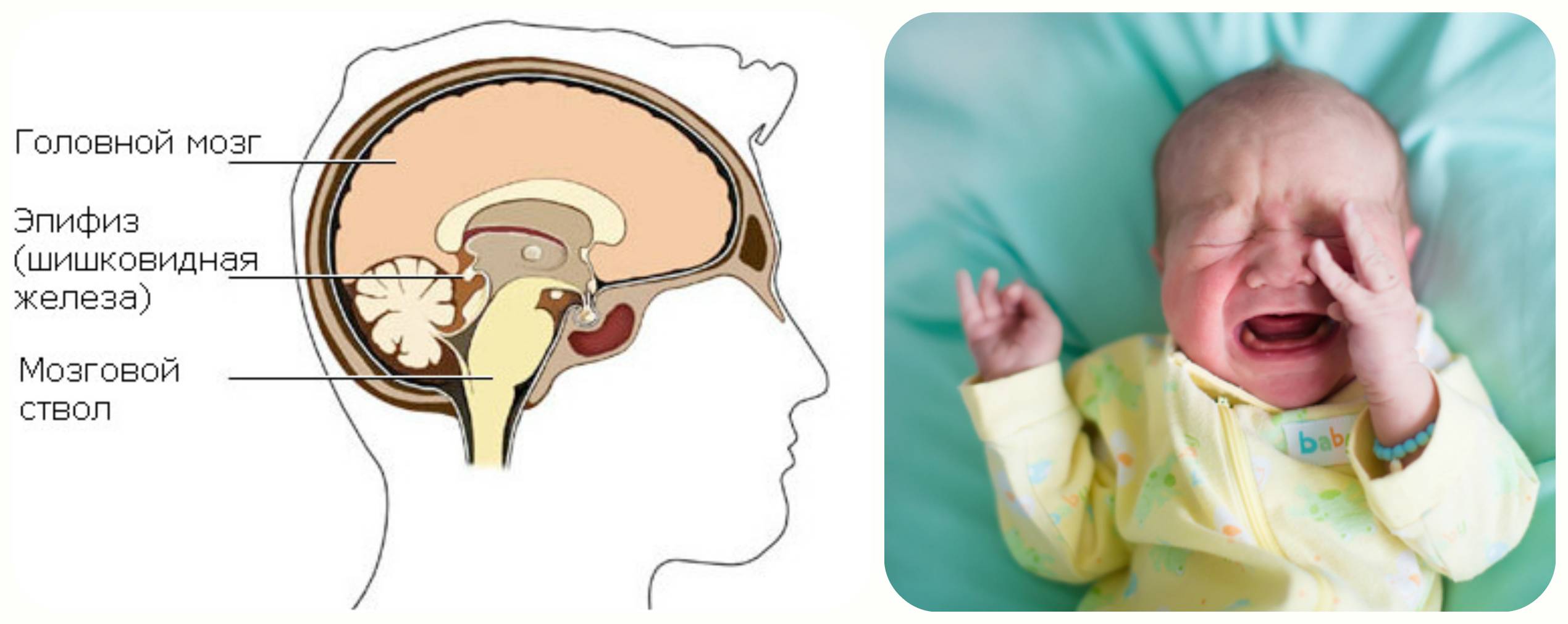 Опасность псевдокисты головного мозга у новорожденного