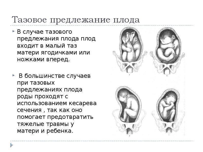 На каком сроке ребенок уже не переворачивается. когда дети переворачиваются и какое положение является нормальным в утробе матери