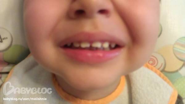 Ушиб зуба, боль в зубе после удара: последствия ушиба - много зубов